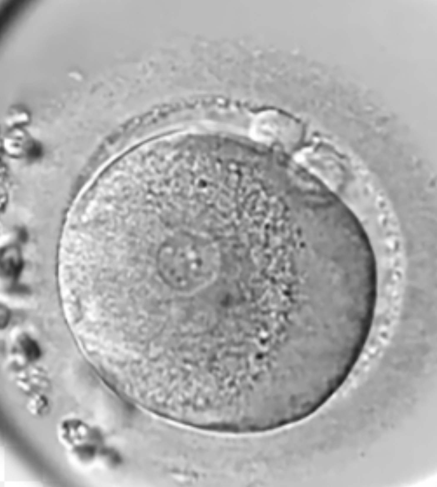 A 1PN atypically fertilised embryo