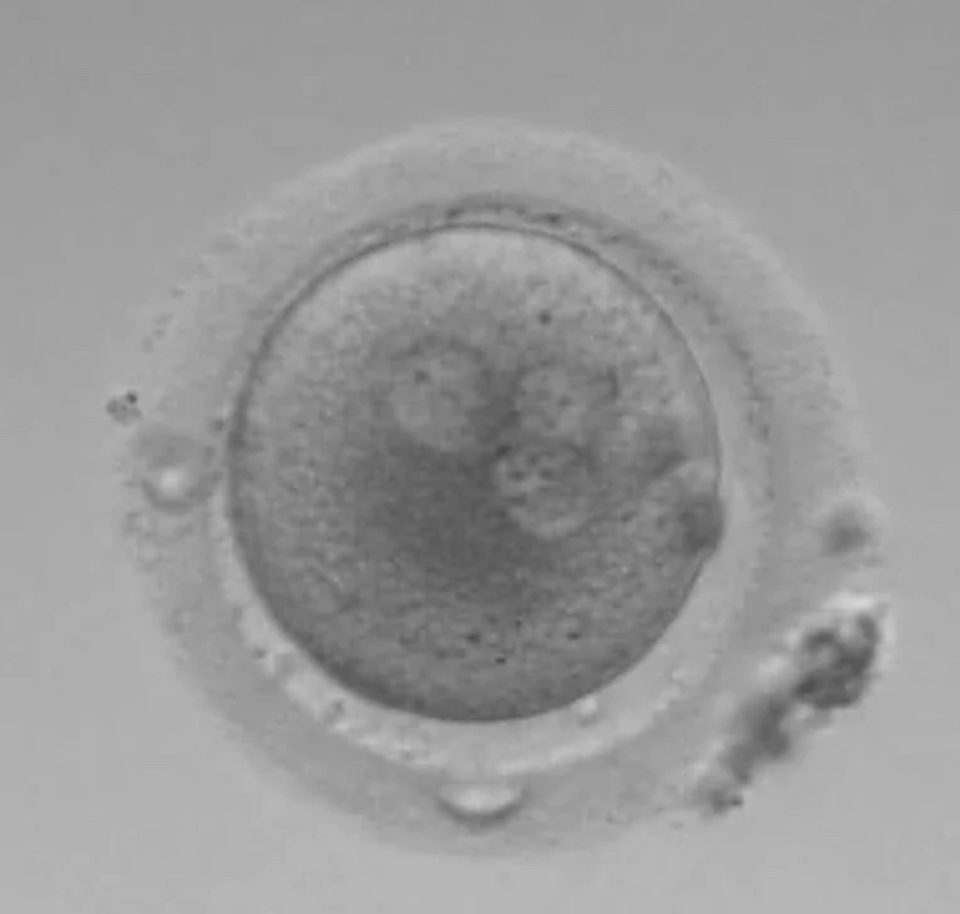 A 3PN atypically fertilised embryo