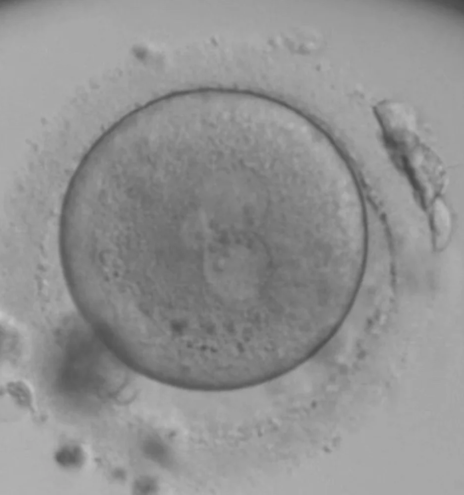 A 2.1PN atypically fertilised embryo